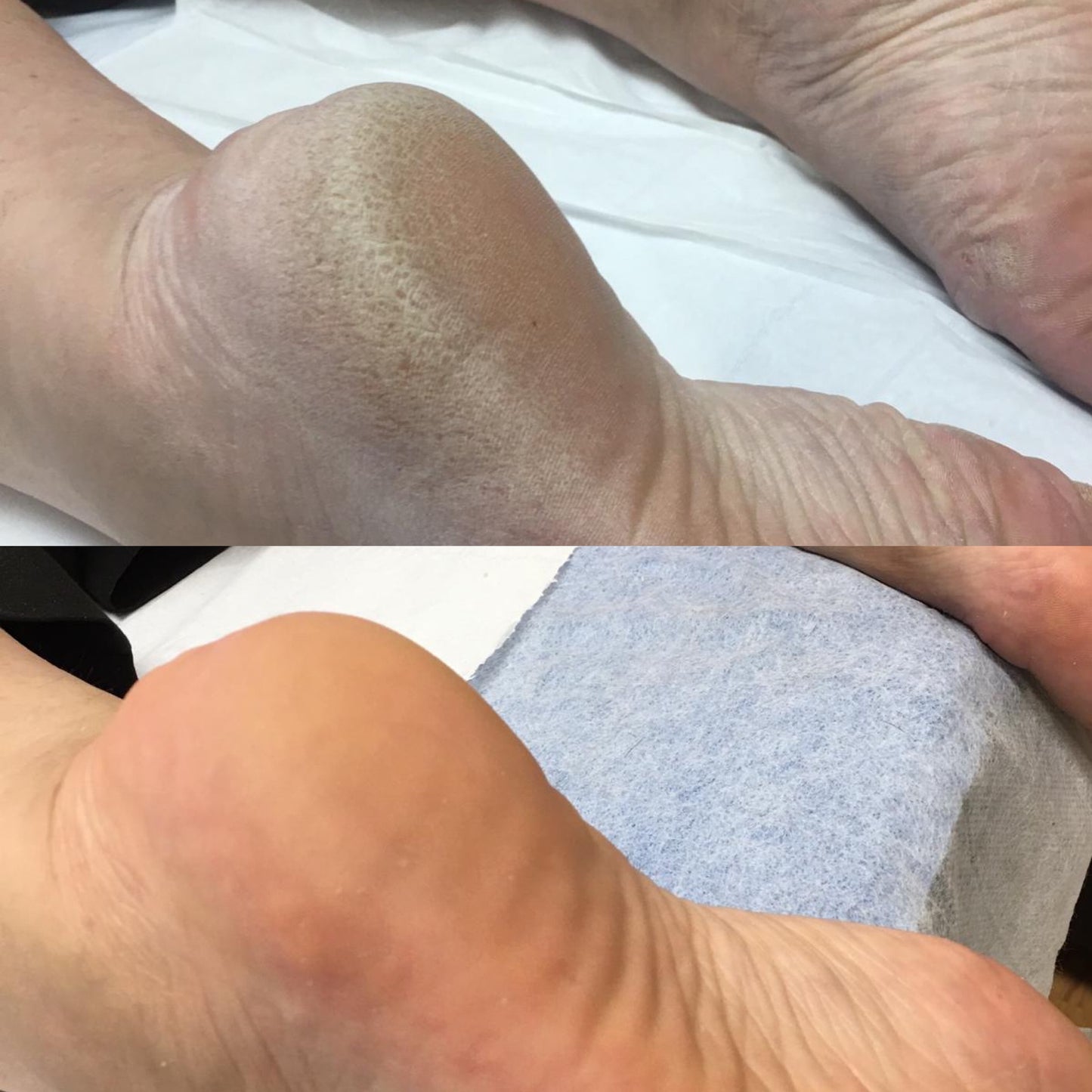 Callus Peel Pedicure (1 hour)