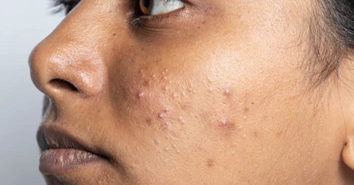 Refine Oily/Acne Skin Facial (1h 20 min.)